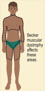 Becker syndrome