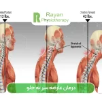 درمان عارضه سر به جلو با فیزیوتراپی (Forward Head Posture)