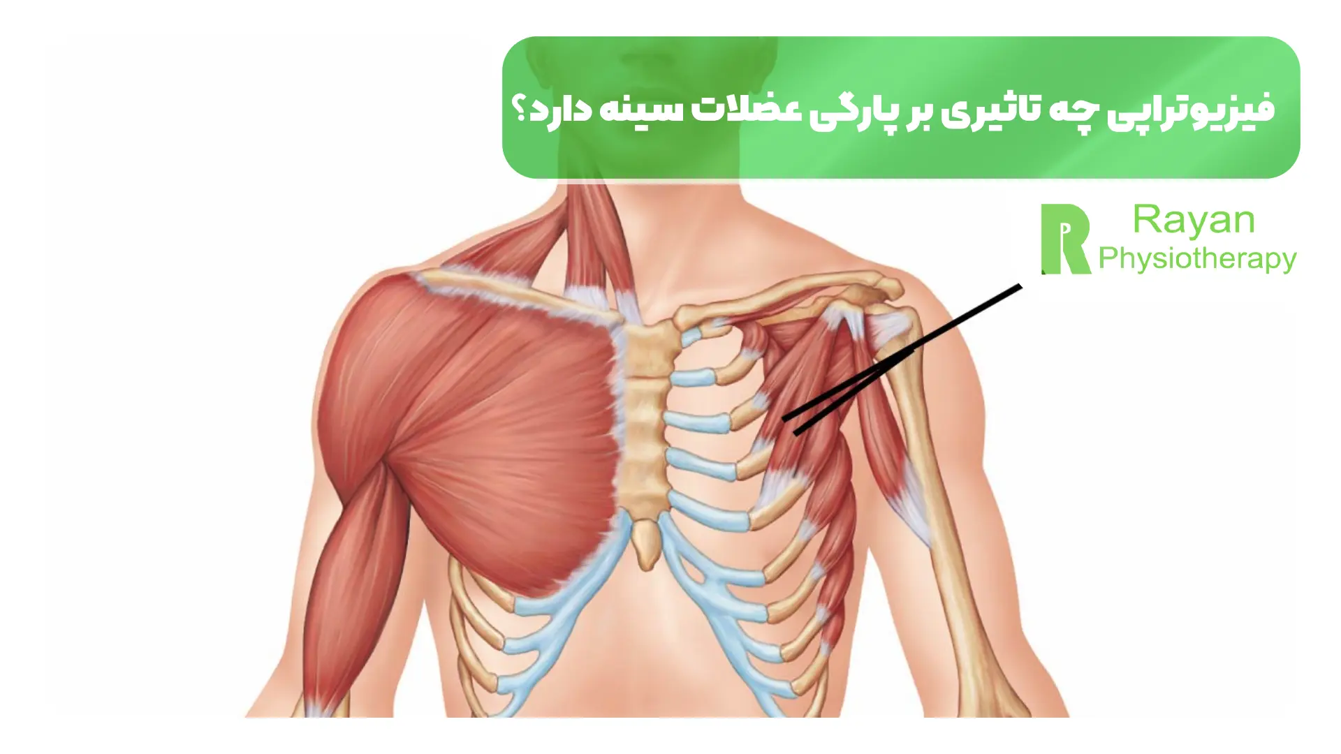 فیزیوتراپی چه تاثیری بر پارگی عضلات سینه دارد؟