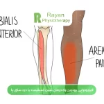 فیزیوتراپی بهترین راه درمان شین اسپلینت یا درد ساق پا