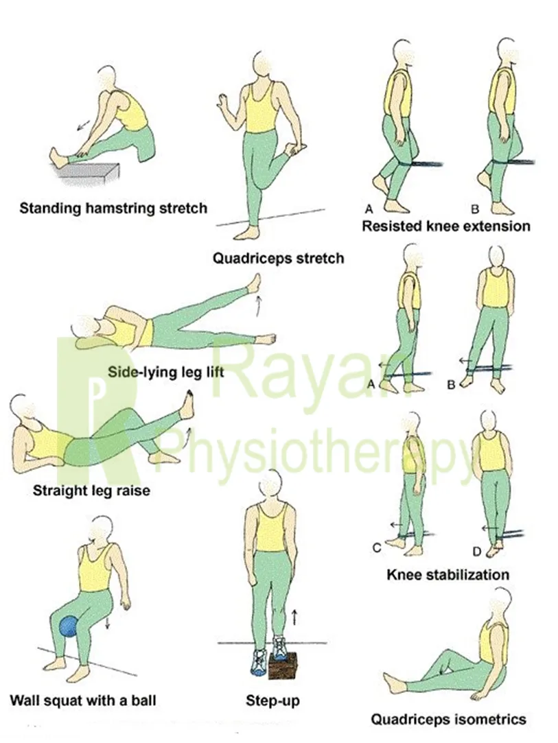 تمرینات ورزشی برای درمان کندرومالاسی کشکک زانو 