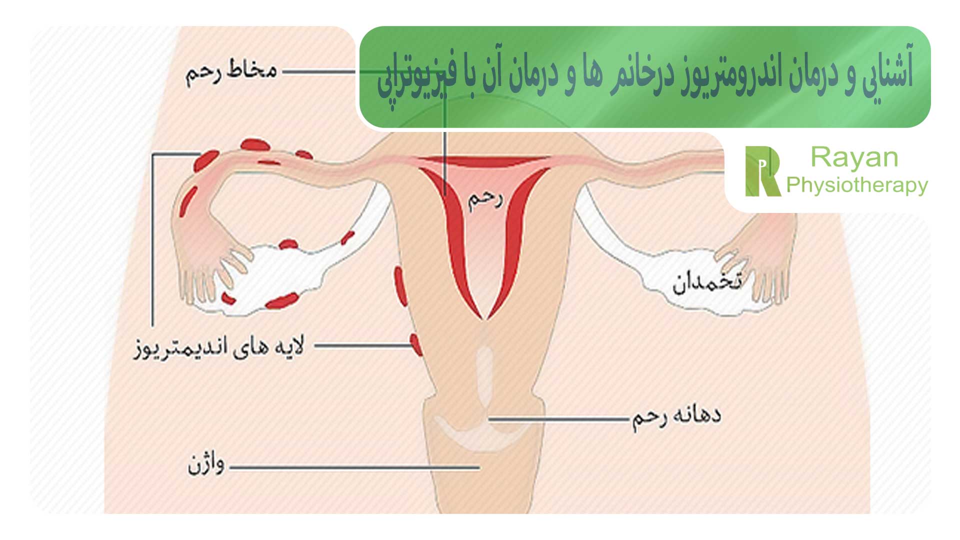 آشنایی و درمان اندرومتریوز درخانم ها و درمان آن با فیزیوتراپی