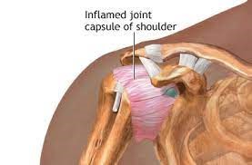 frozen shoulder