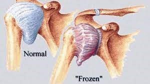 frozen shoulder