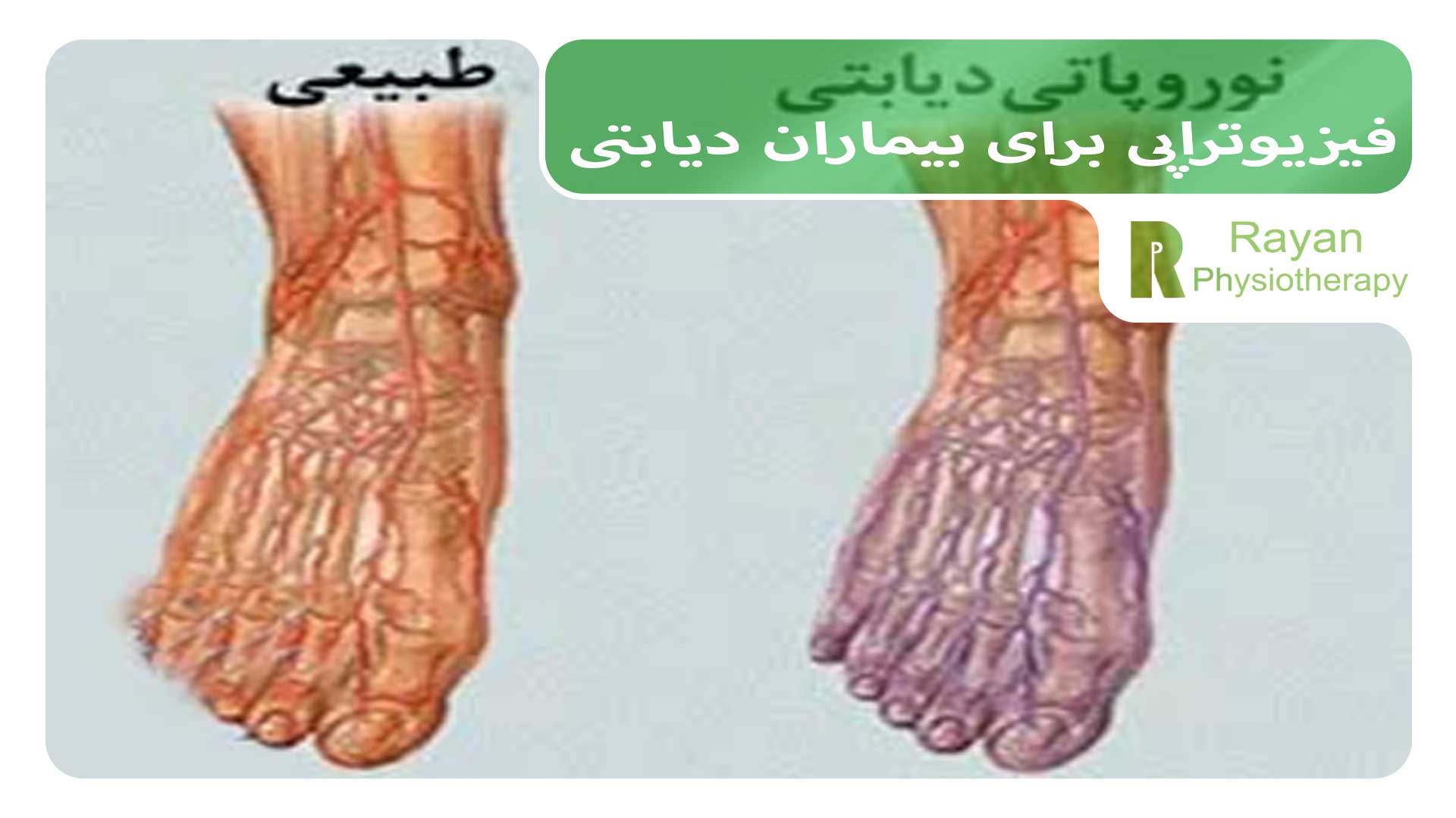 فیزیوتراپی برای بیماران دیابتی : نکات و تمرینات مفید