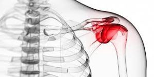 frozen shoulder
