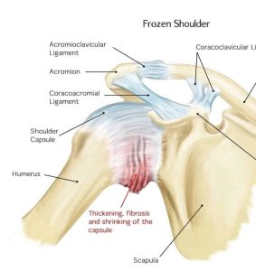 frozen shoulder