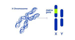 Becker syndrome