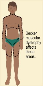 Becker syndrome