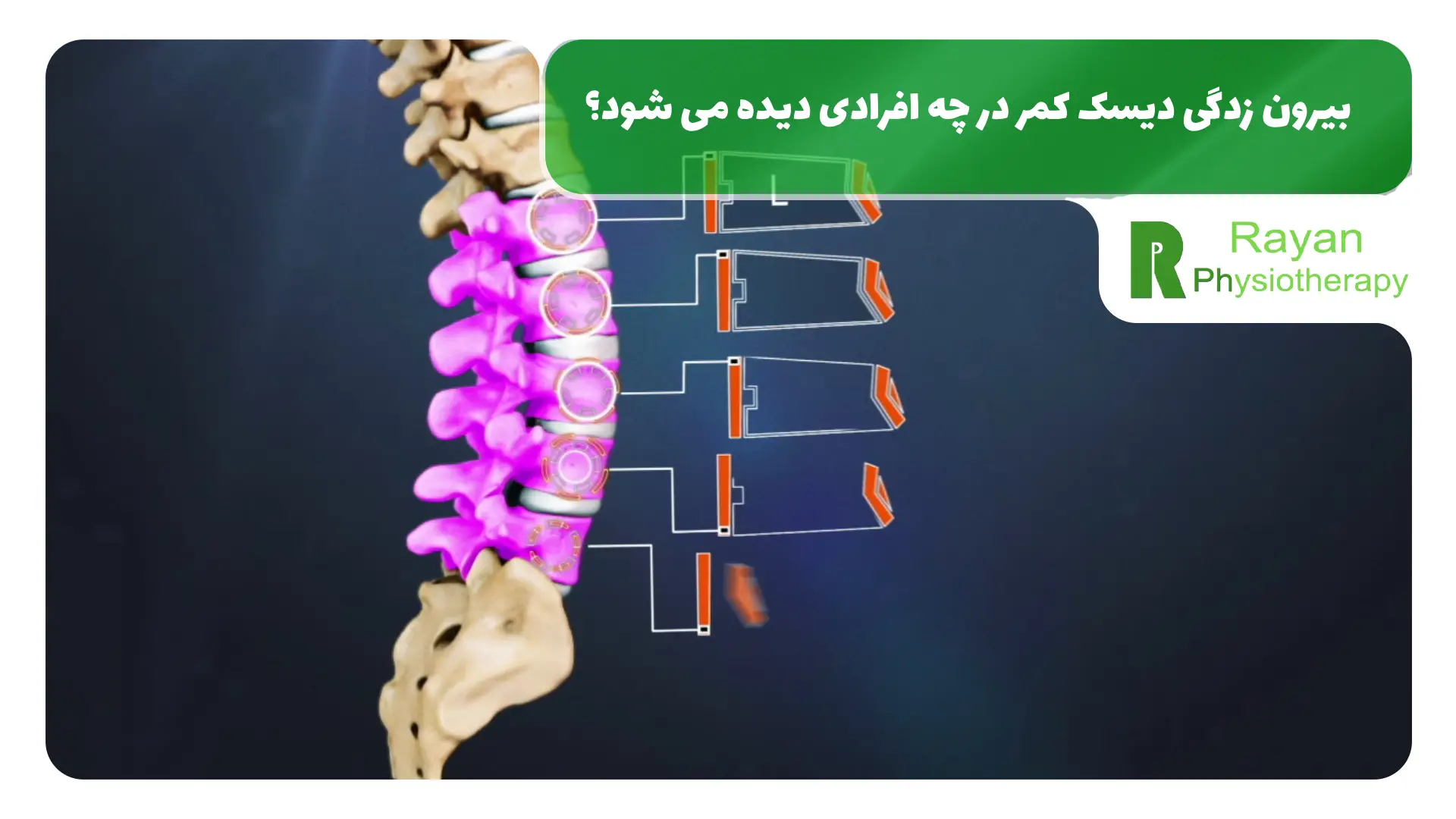 بیرون زدگی دیسک کمر در چه افرادی دیده می شود؟