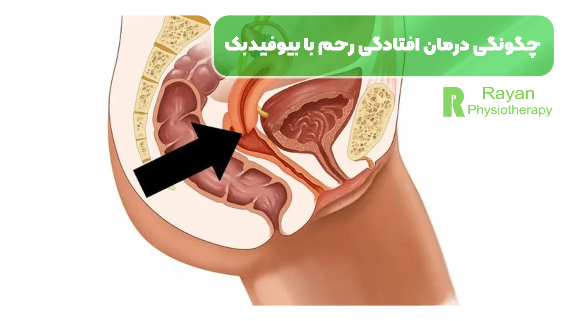چگونگی درمان افتادگی رحم با بیوفیدبک