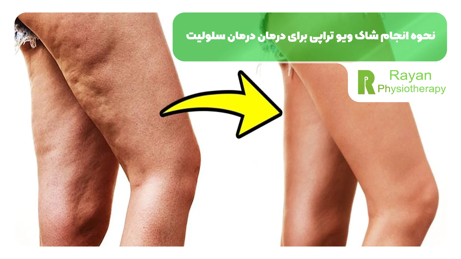 نحوه انجام شاک ویو تراپی برای درمان درمان سلولیت