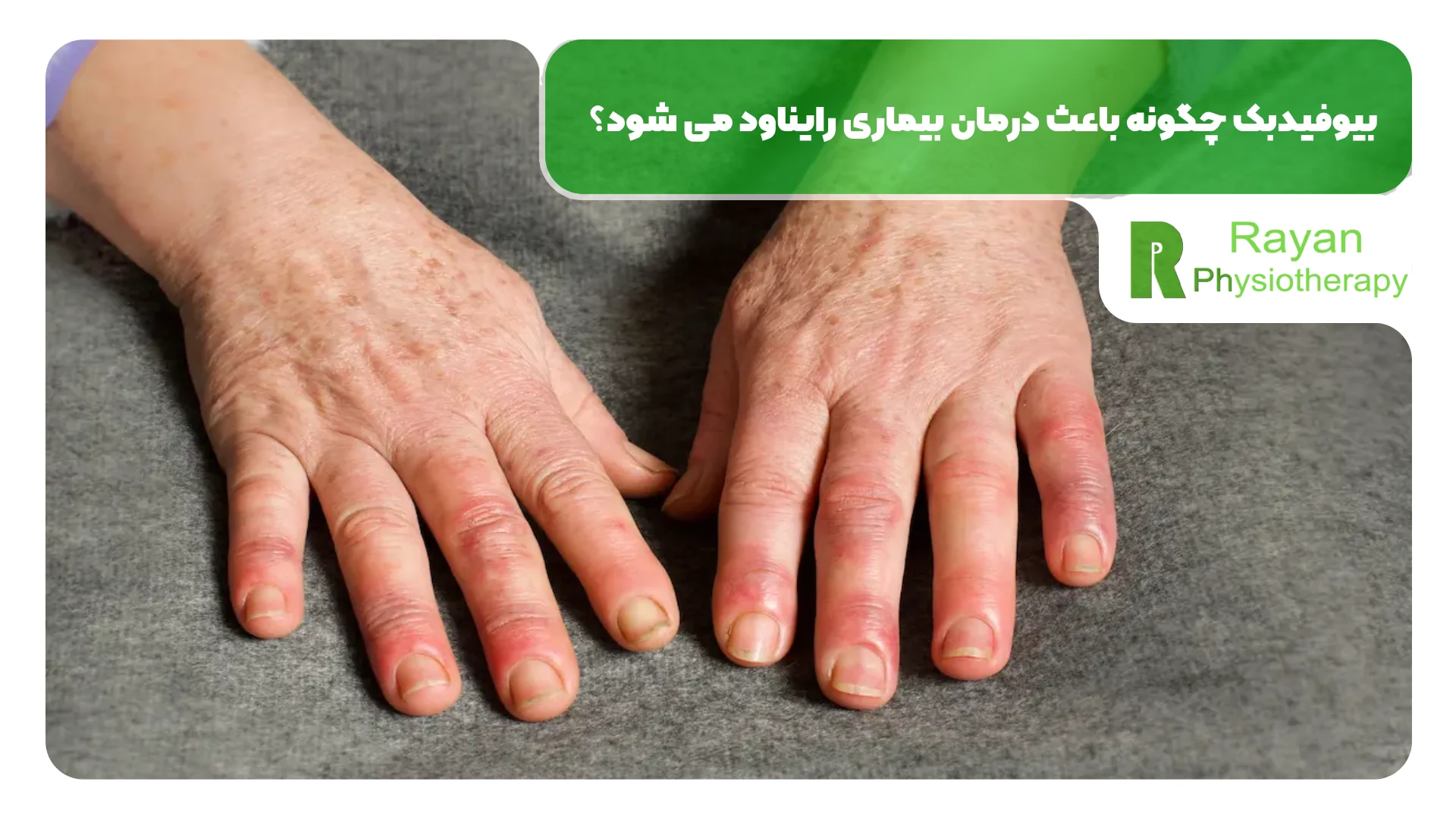 بیوفیدبک چگونه باعث درمان بیماری رایناود می شود؟
