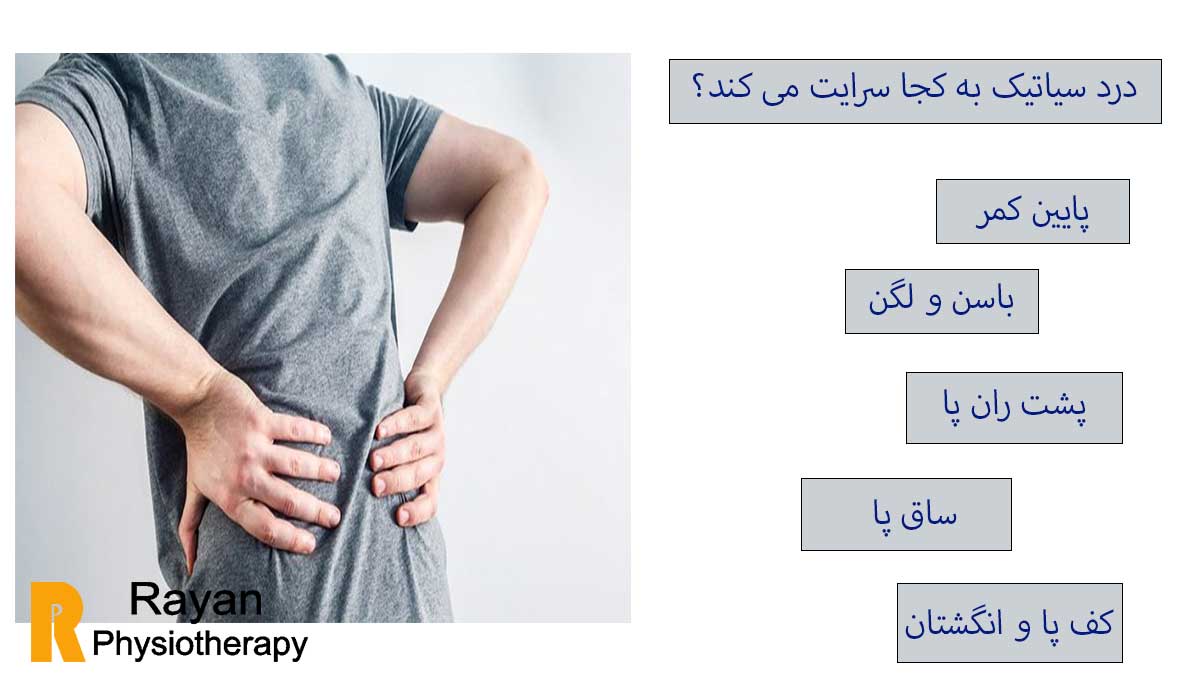 سیاتیک چیست و چگونه درمان می شود؟