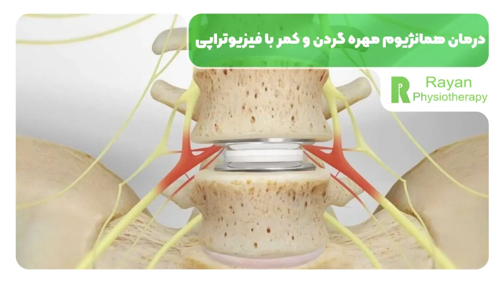 نقش فیزیوتراپی در درمان همانژیوم مهره گردن و کمر