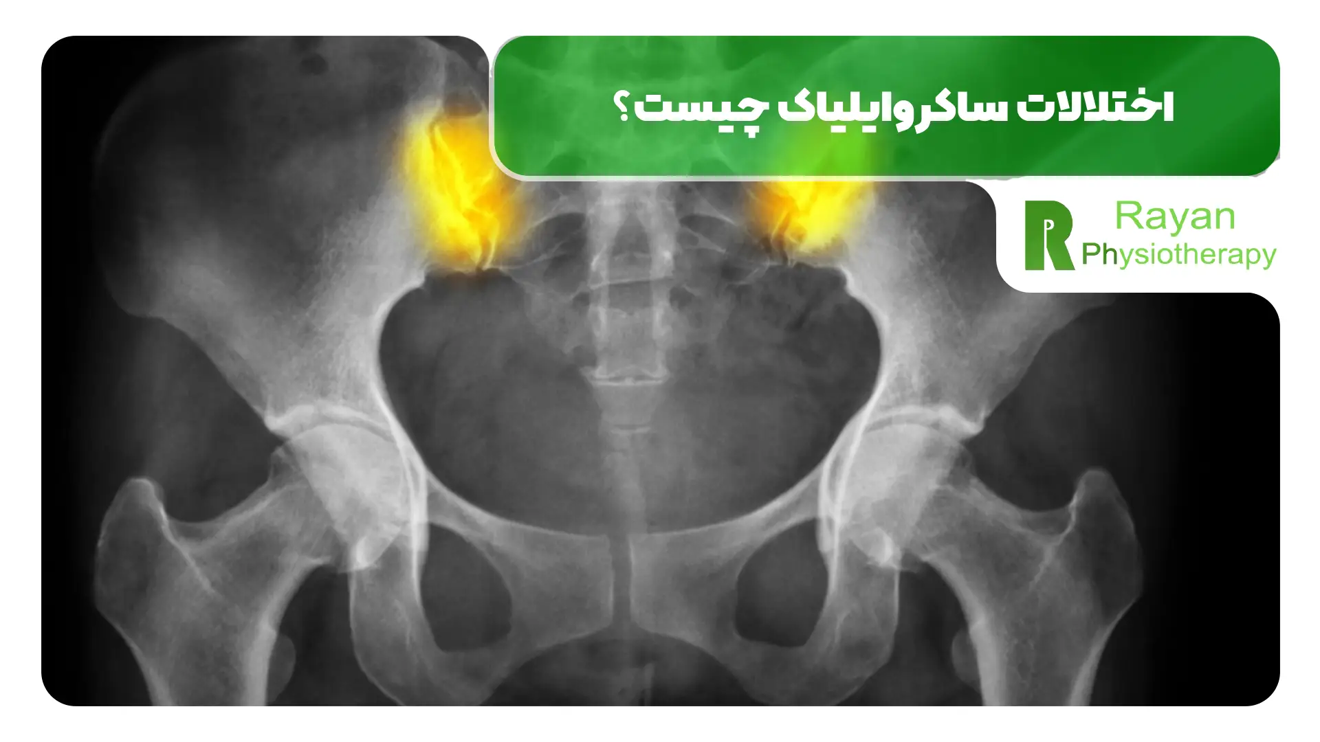 اختلالات ساکروایلیاک چیست؟