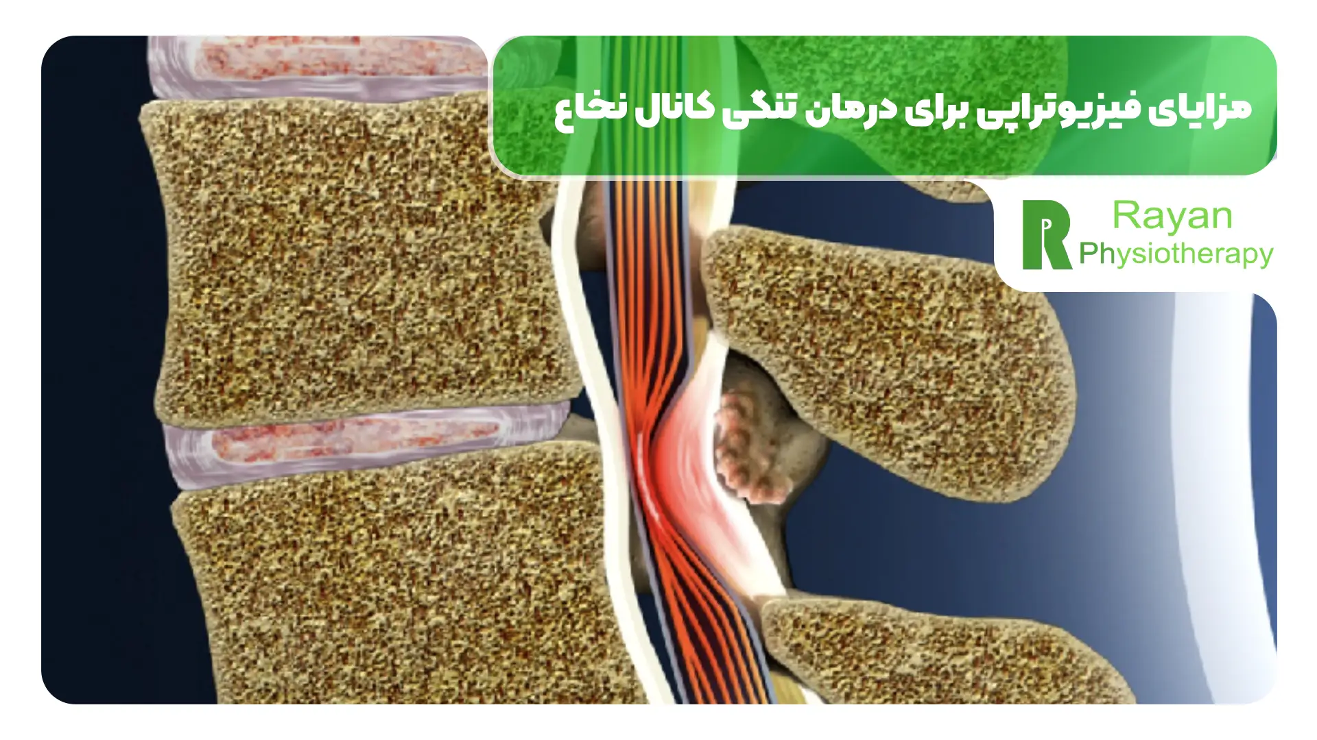 مزایای فیزیوتراپی برای درمان تنگی کانال نخاع