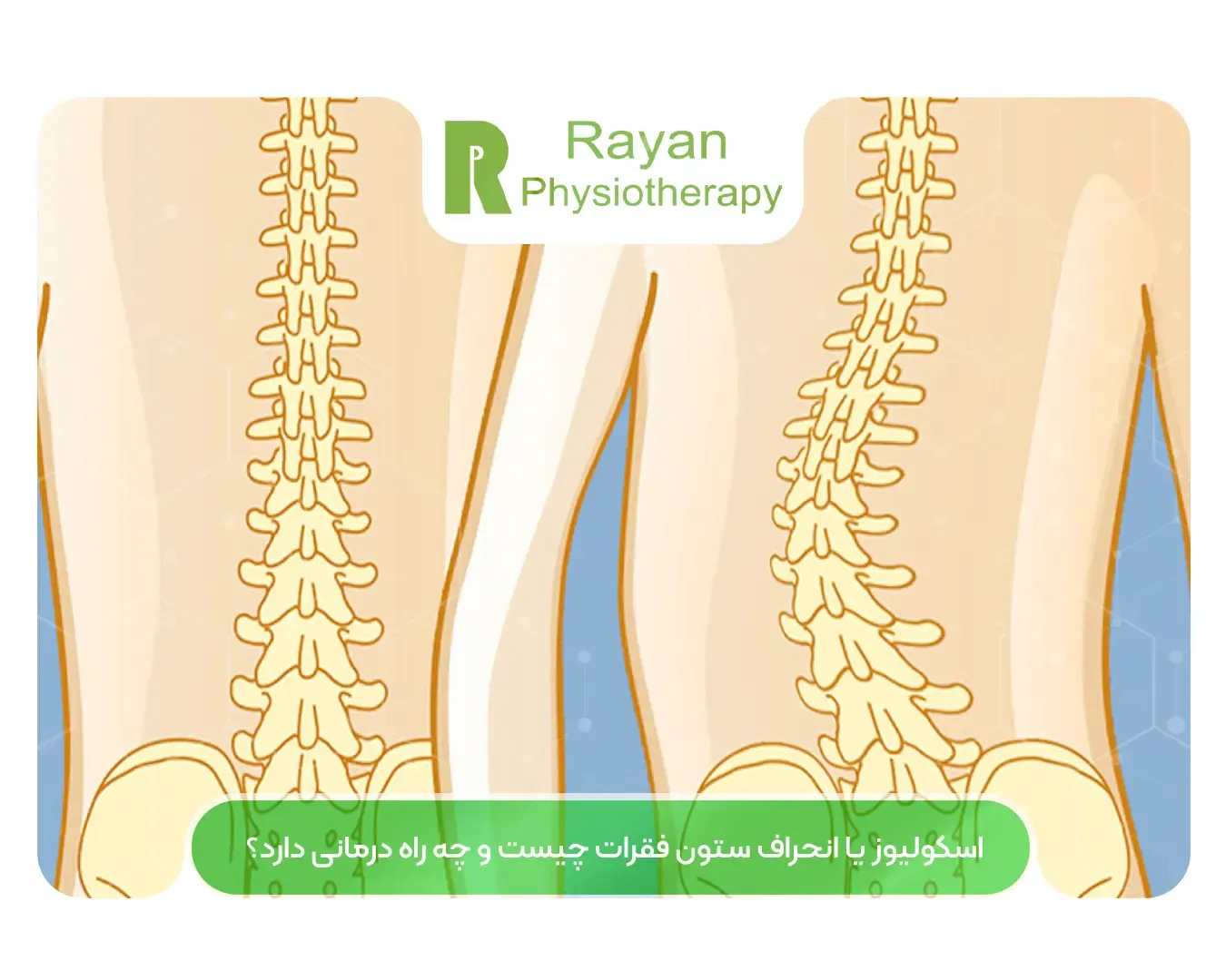 درمان اسکولیوز یا انحراف ستون فقرات با فیزیوتراپی