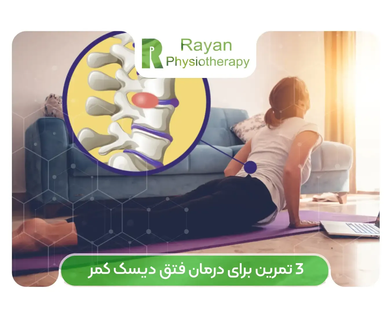 3 تمرین برای درمان فتق دیسک کمر