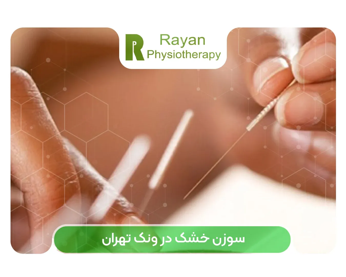 سوزن خشک در ونک تهران