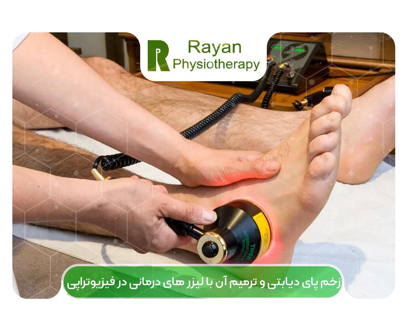 زخم پای دیابتی و ترمیم آن با لیزر های درمانی در فیزیوتراپی