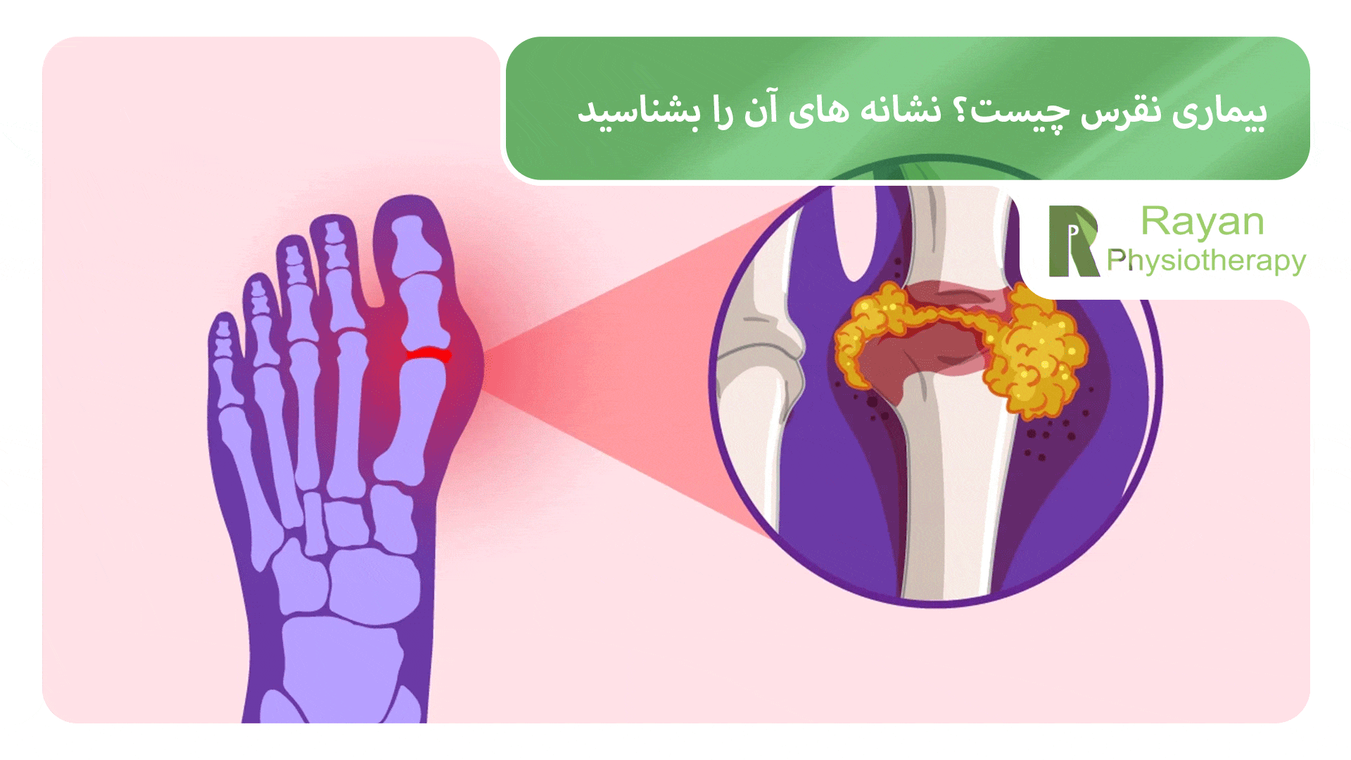نقرس چیست؟