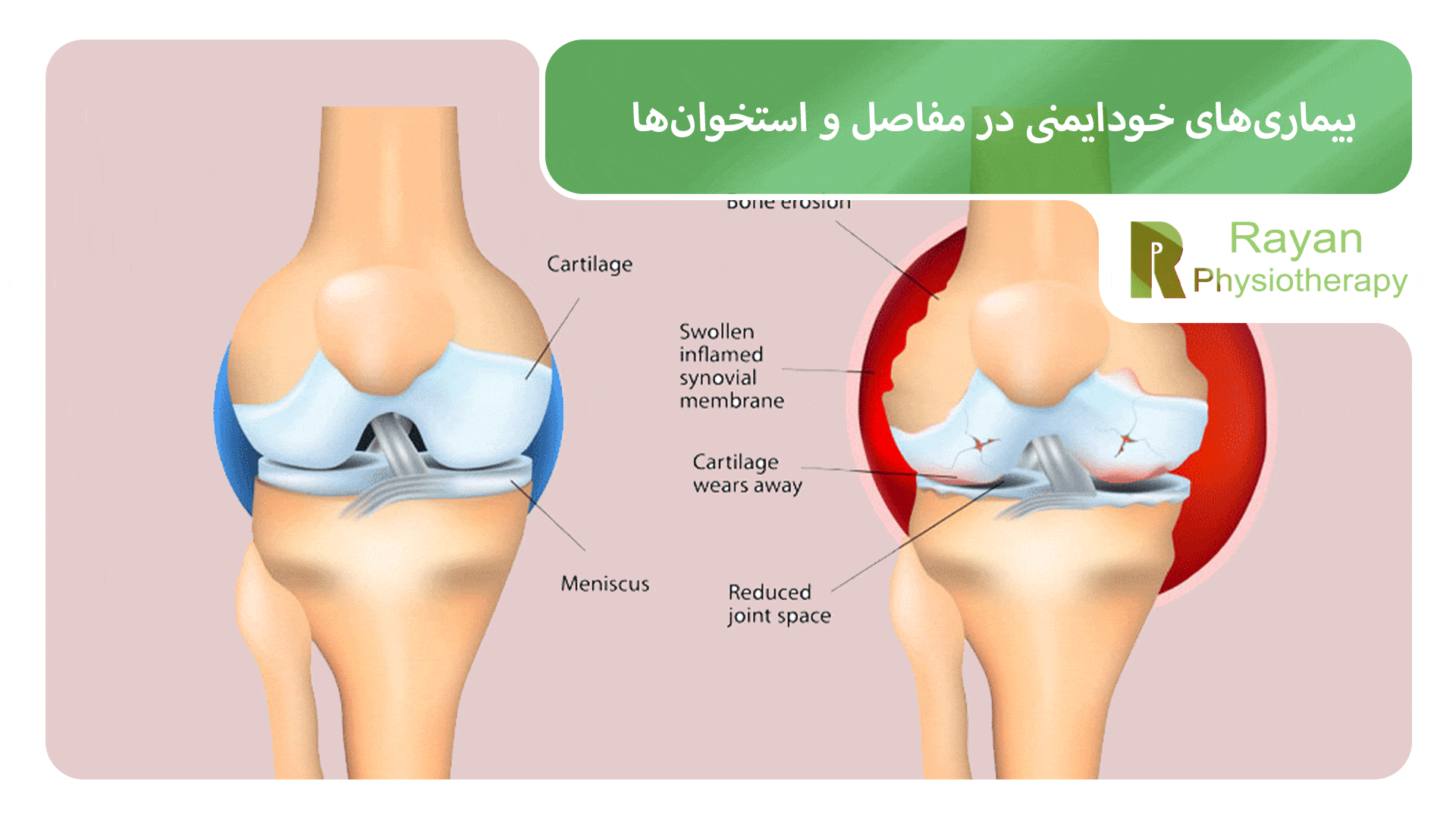 انواع بیماری‌های خودایمنی در مفاصل و استخوان‌ها
