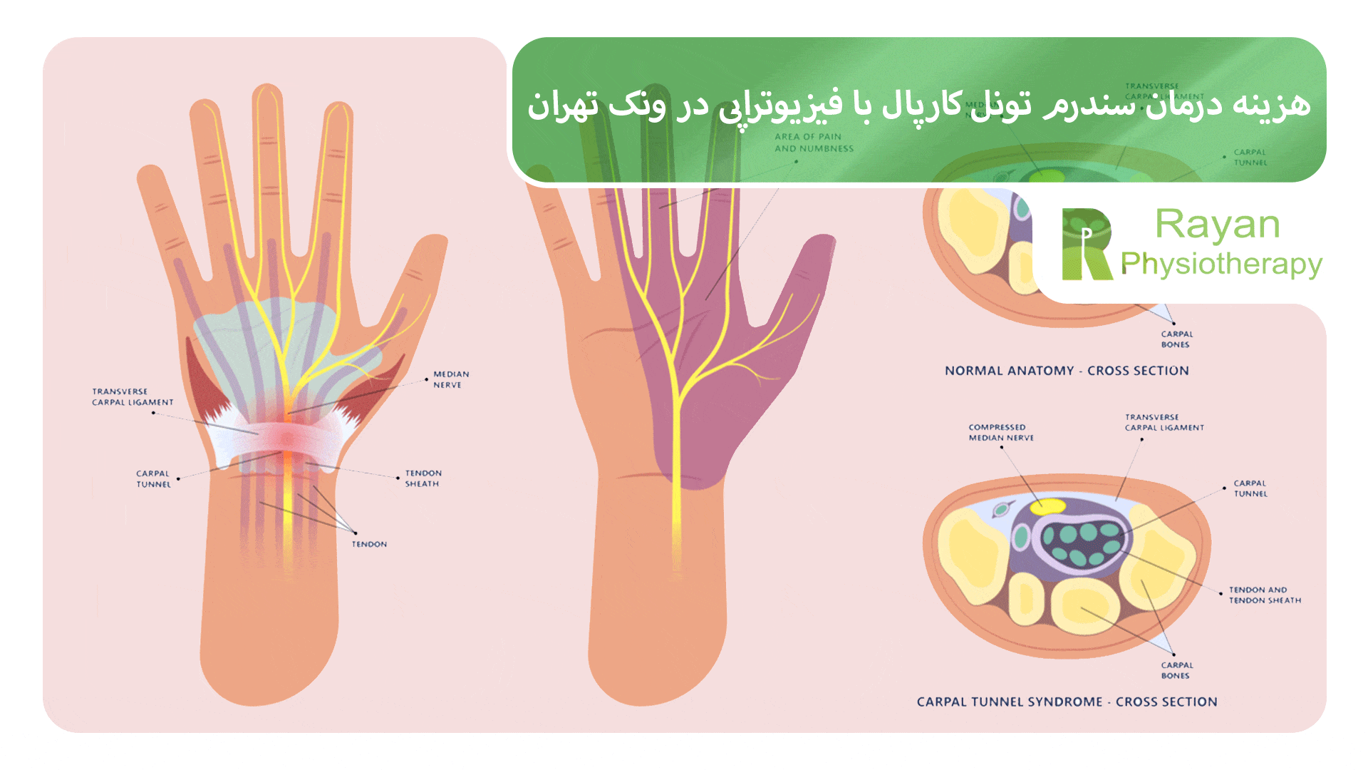 هزینه درمان سندرم تونل کارپال با فیزیوتراپی در ونک تهران