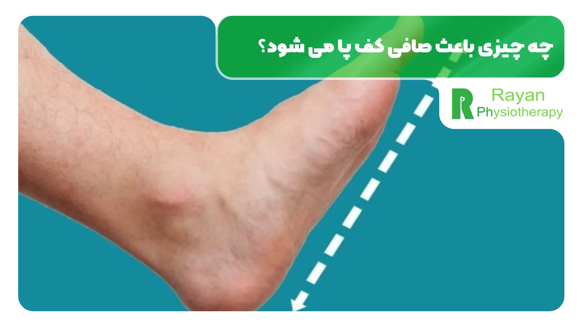 چه چیزی باعث صافی کف پا می شود؟