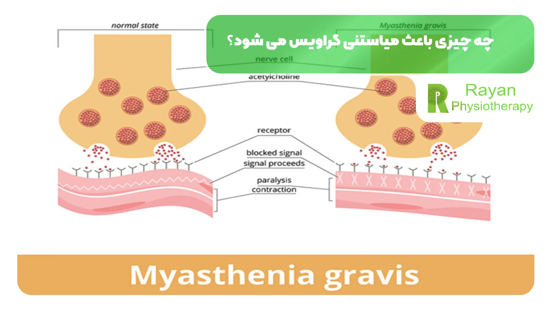 چه چیزی باعث میاستنی گراویس می شود؟