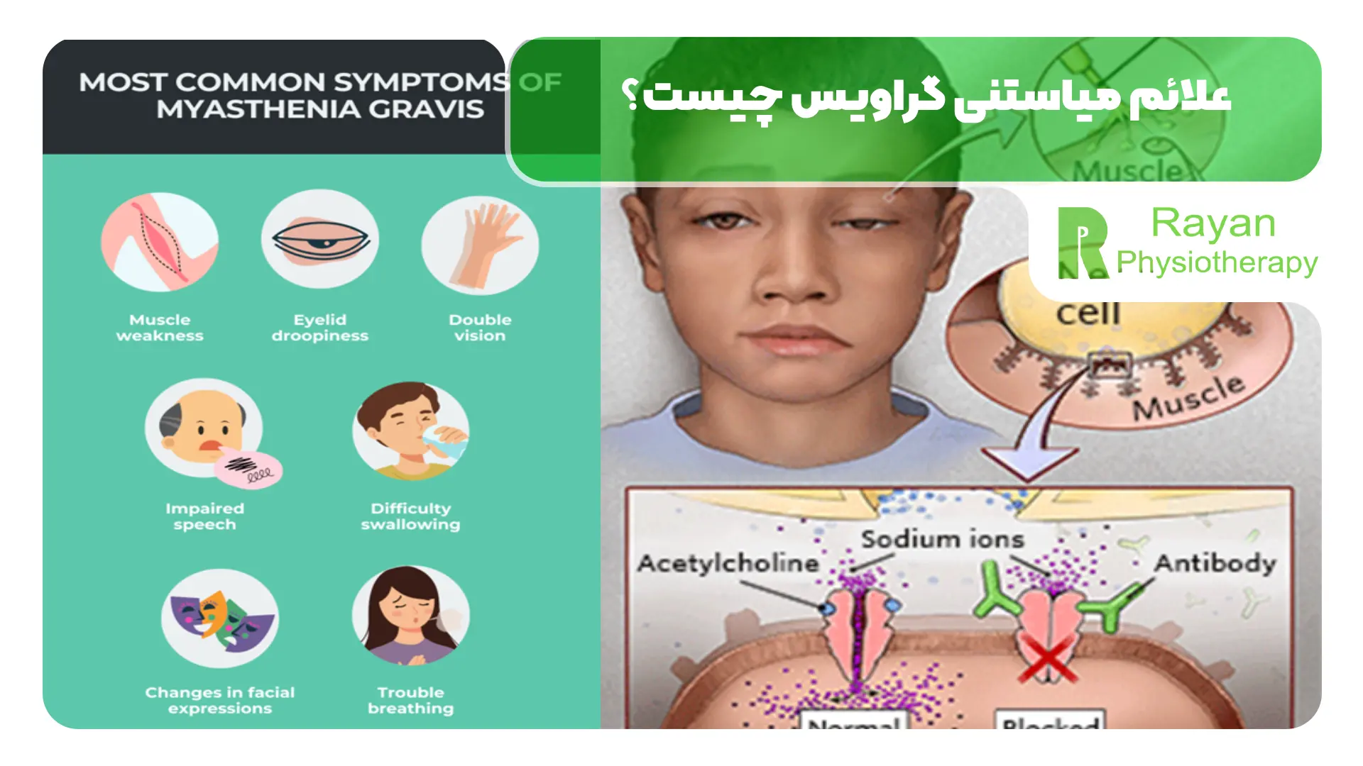 علائم میاستنی گراویس چیست؟