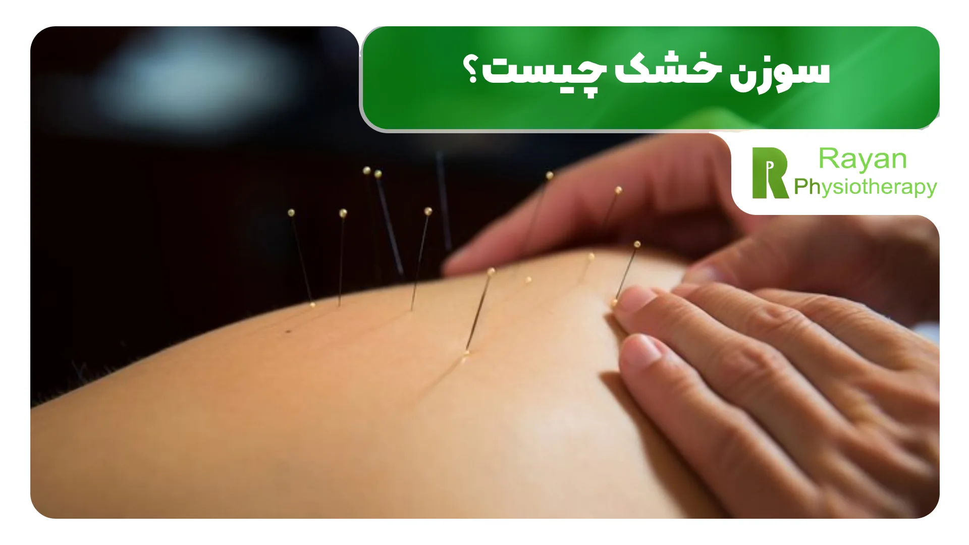 سوزن خشک چیست؟