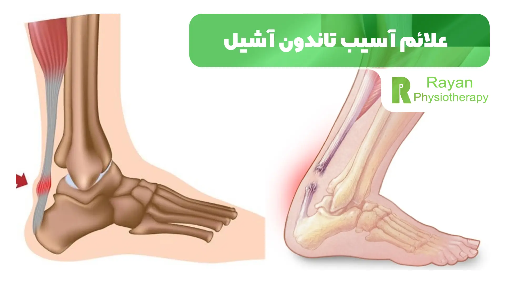 علائم آسیب تاندون آشیل