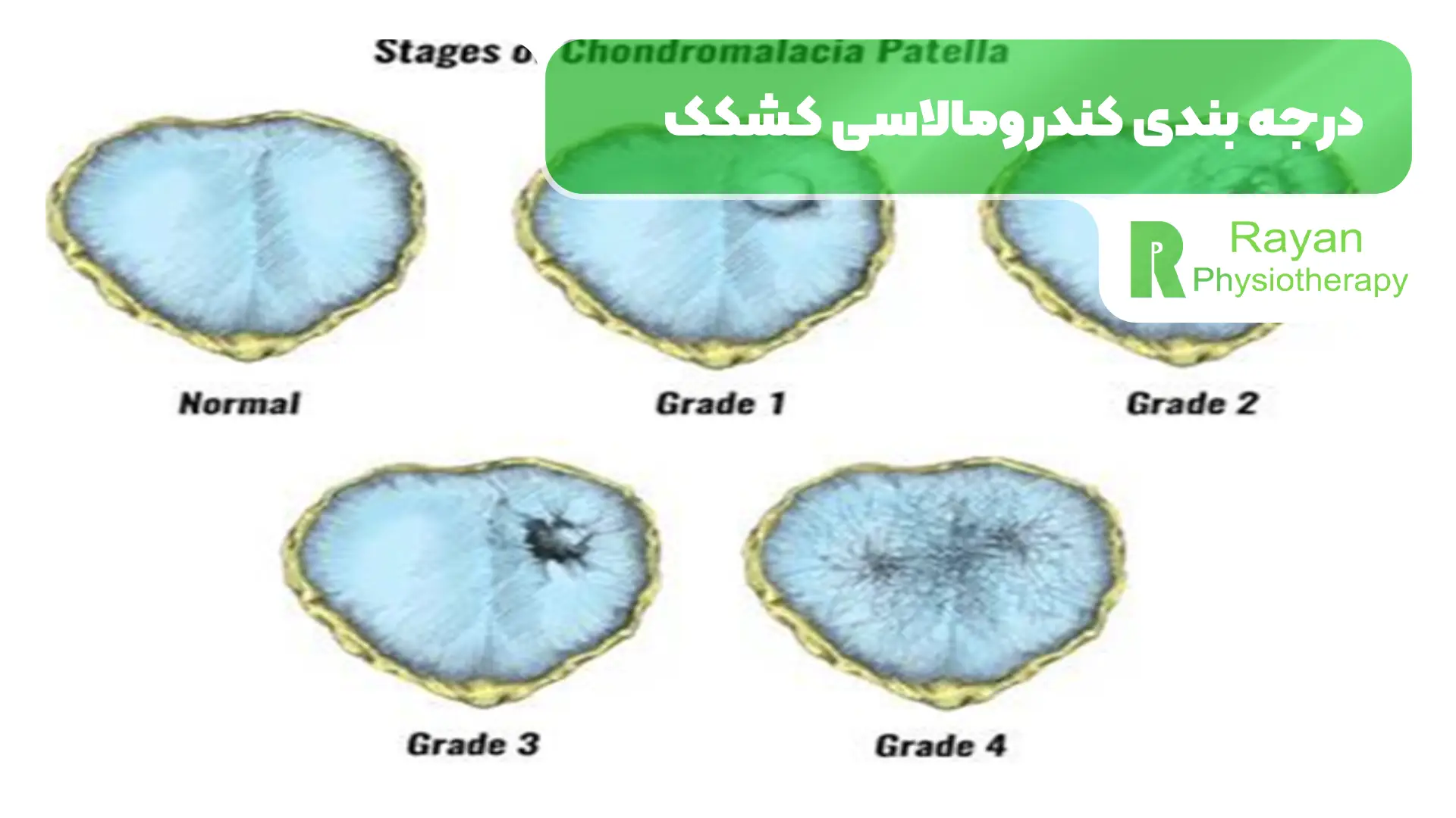 تشخیص و درجه بندی کندرومالاسی کشکک