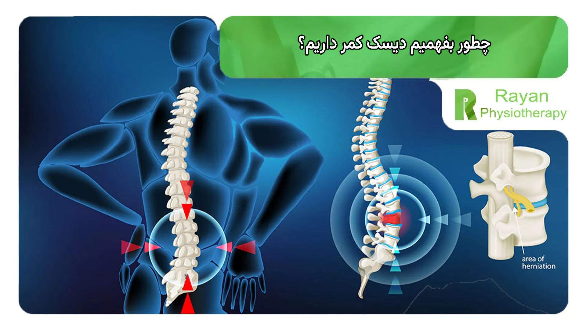 چطور بفهمیم دیسک کمر داریم؟