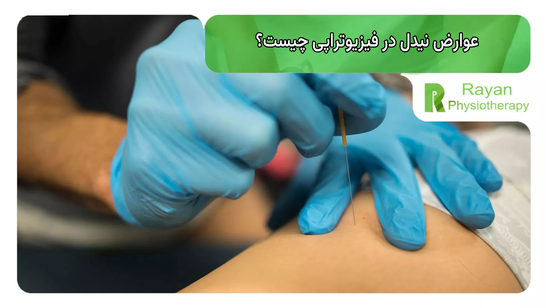 عوارض نیدل در فیزیوتراپی چیست؟