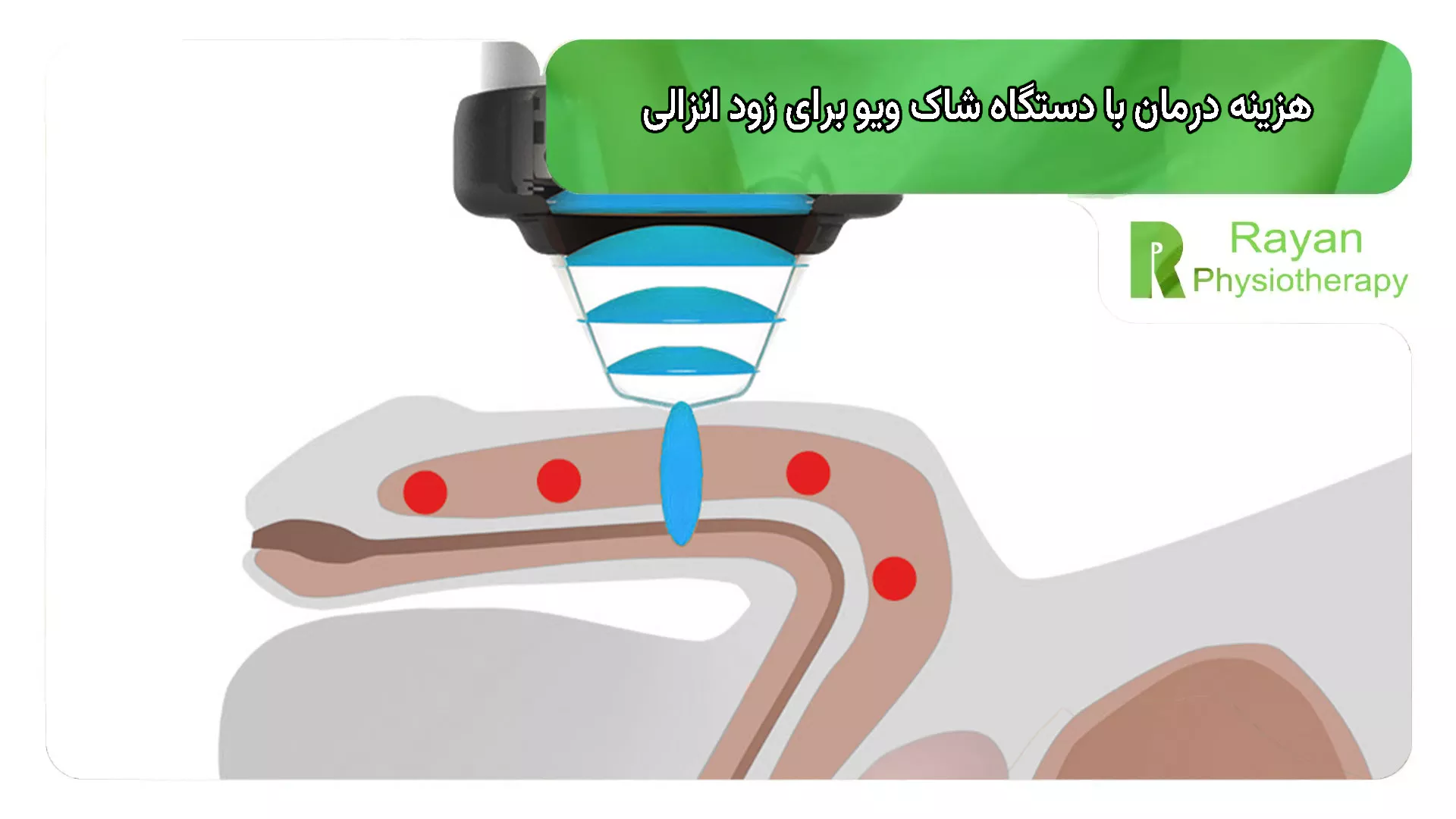 هزینه درمان با دستگاه شاک ویو برای زود انزالی