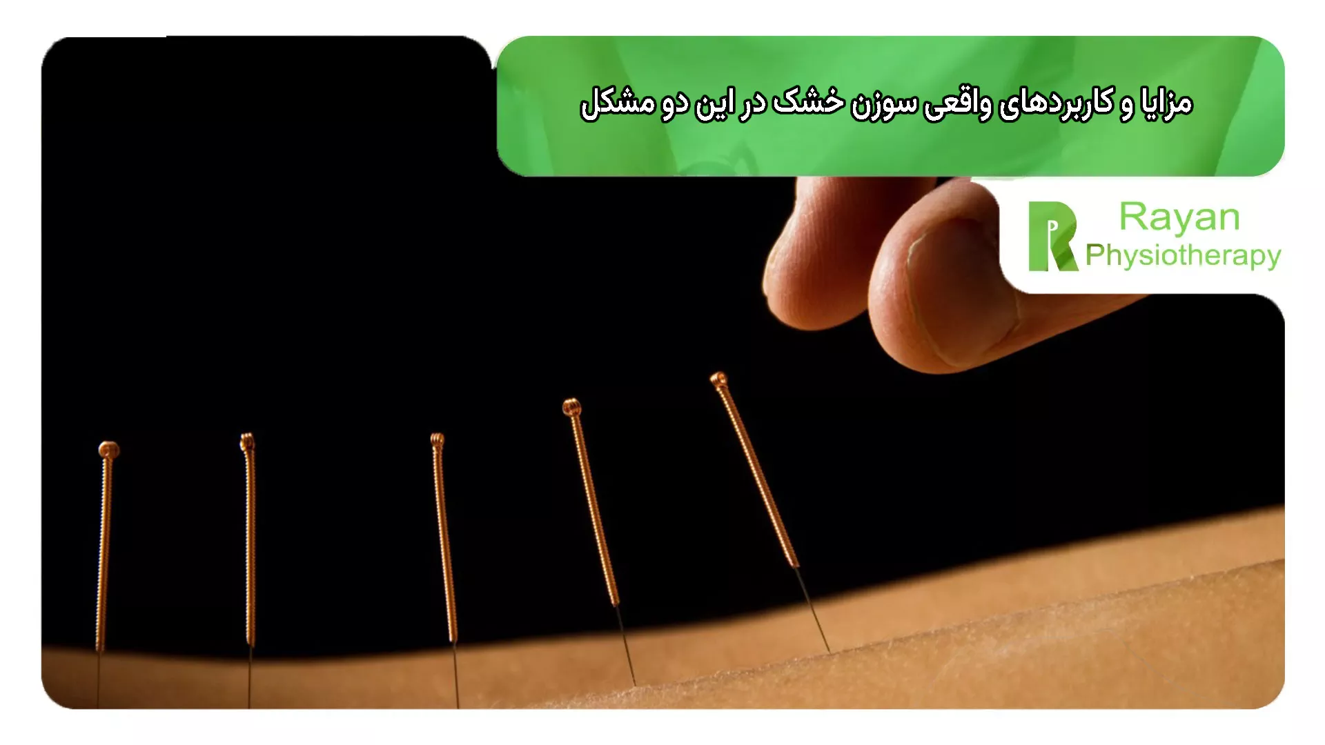مزایا و کاربردهای واقعی سوزن خشک در این دو مشکل