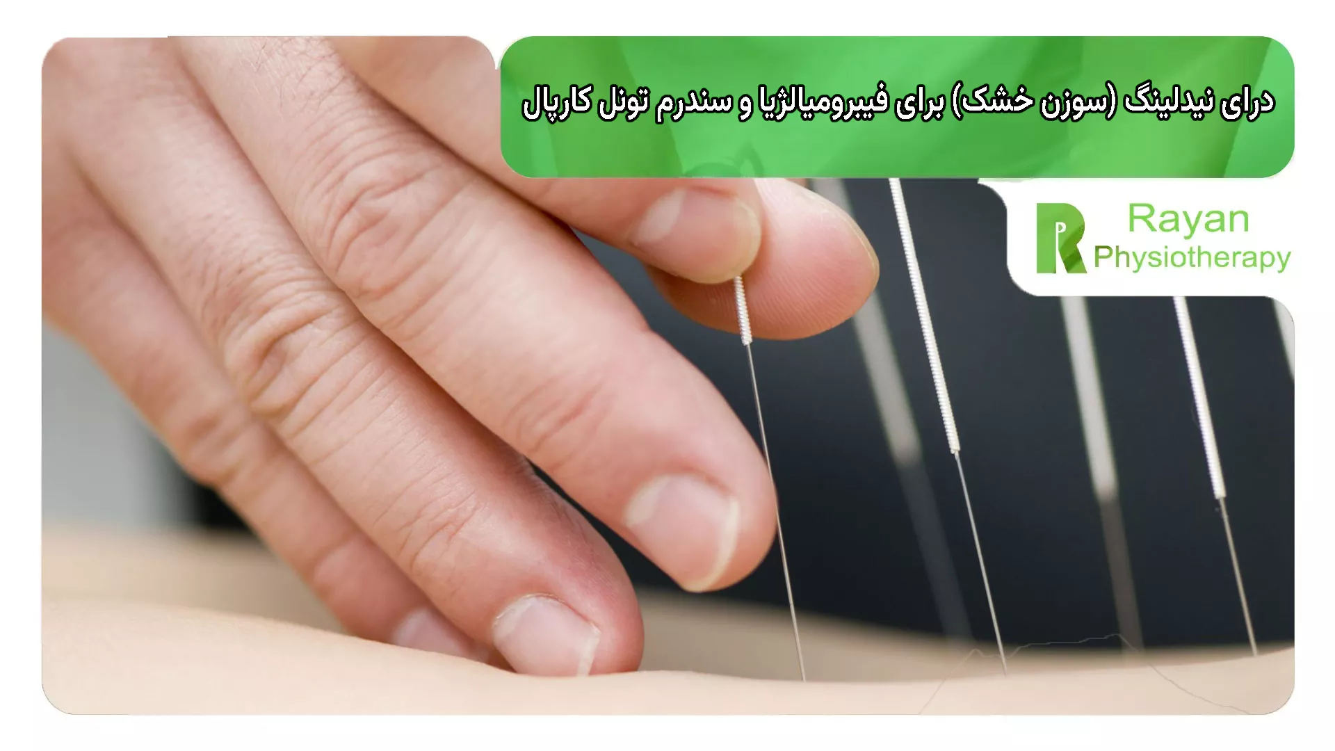 بهترین مرکز درای نیدلینگ در ونک درمان با سوزن خشک برای مبتلایان به فیبرومیالژیا و سندرم تونل کارپال