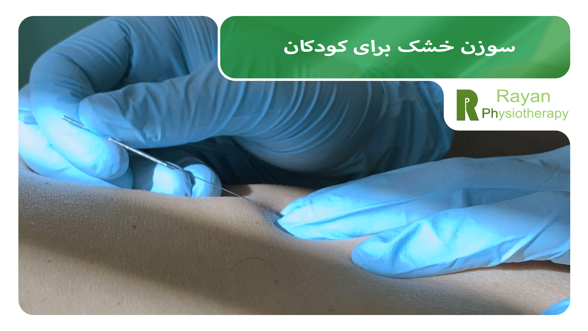سوزن خشک برای کودکان: آیا این روش برای کودکان بی‌خطر است؟