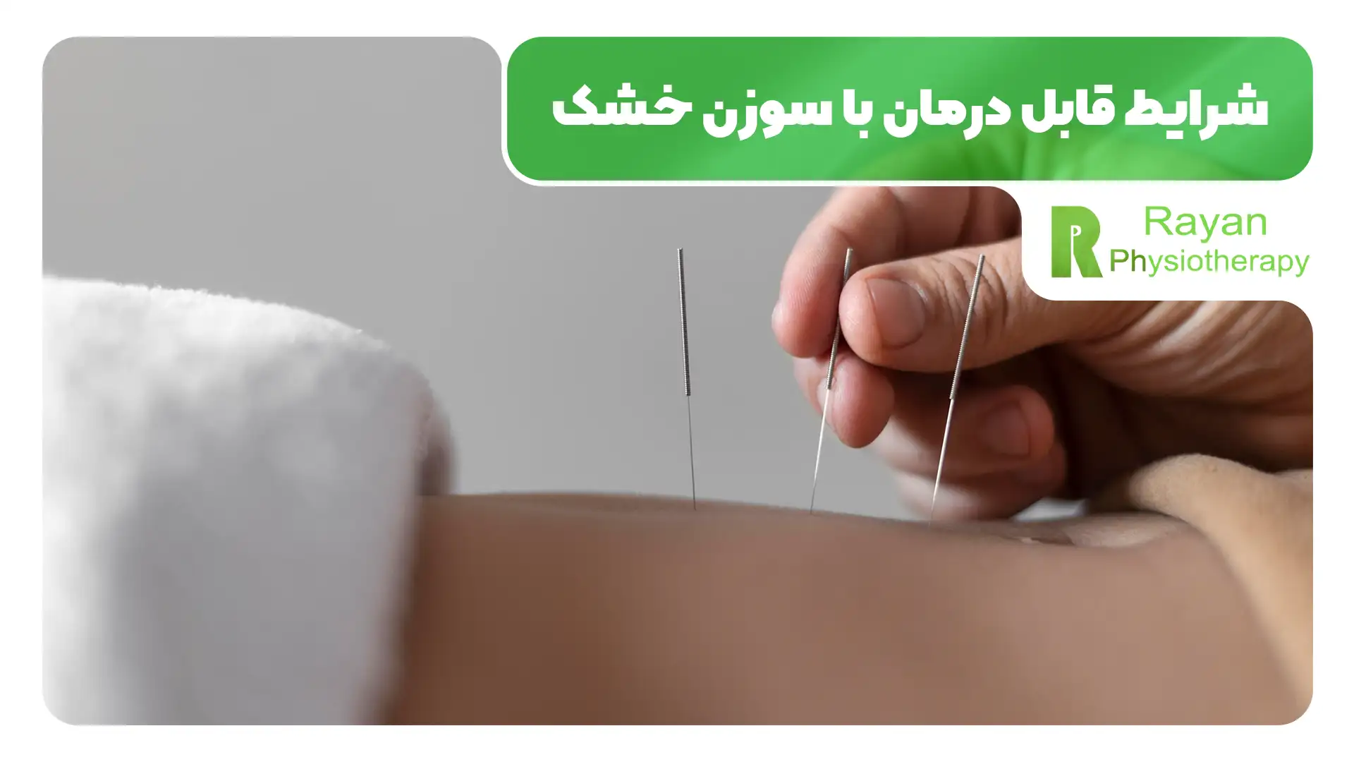سوزن خشک در تهران