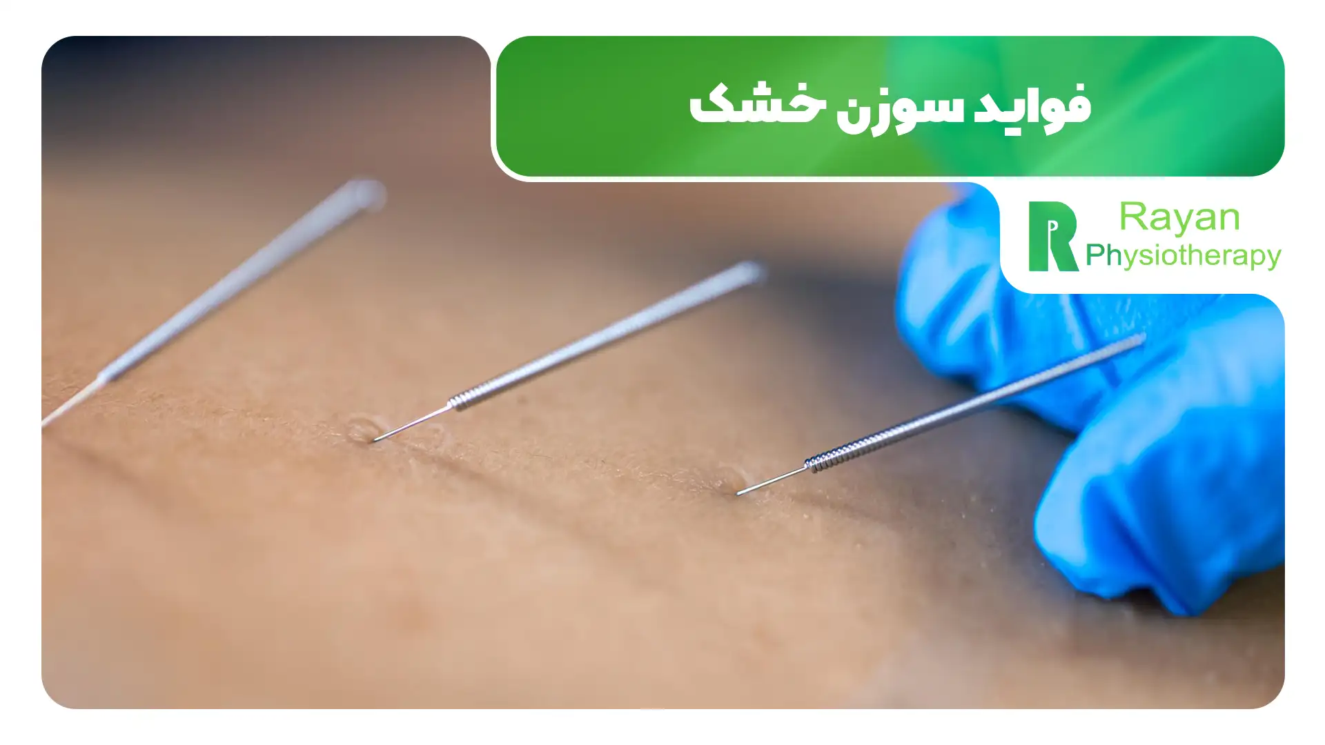 سوزن خشک در تهران