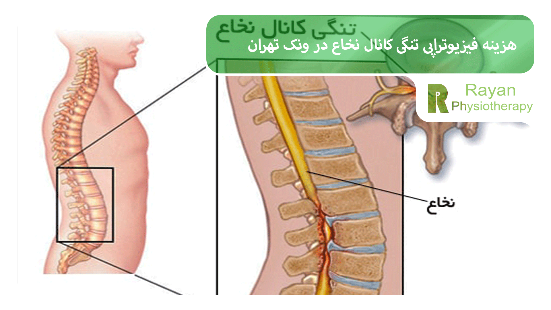 هزینه فیزیوتراپی تنگی کانال نخاع در ونک تهران