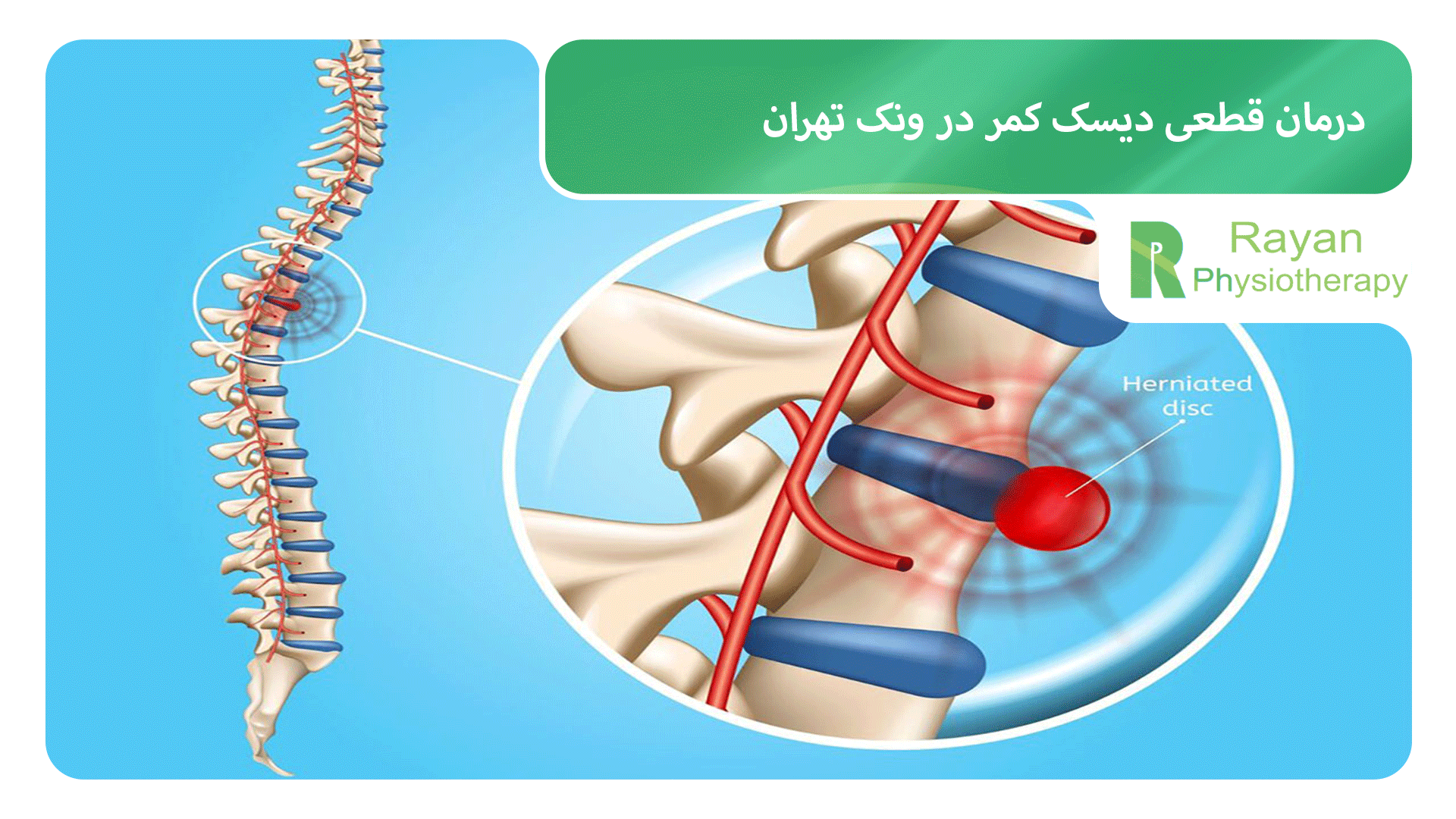 درمان قطعی دیسک کمر در ونک تهران