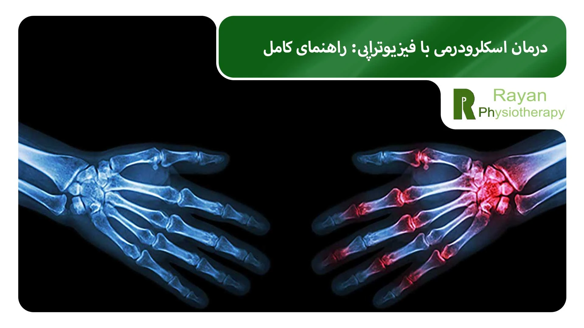 درمان اسکلرودرمی با فیزیوتراپی: راهنمای کامل
