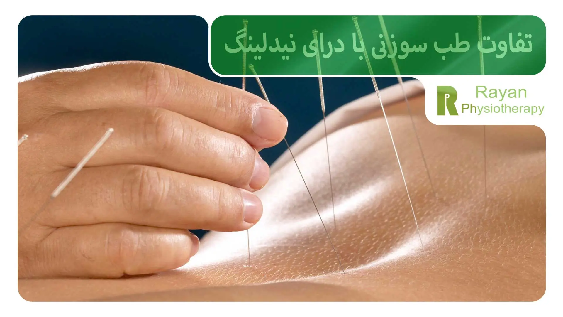 تفاوت طب سوزنی با درای نیدلینگ