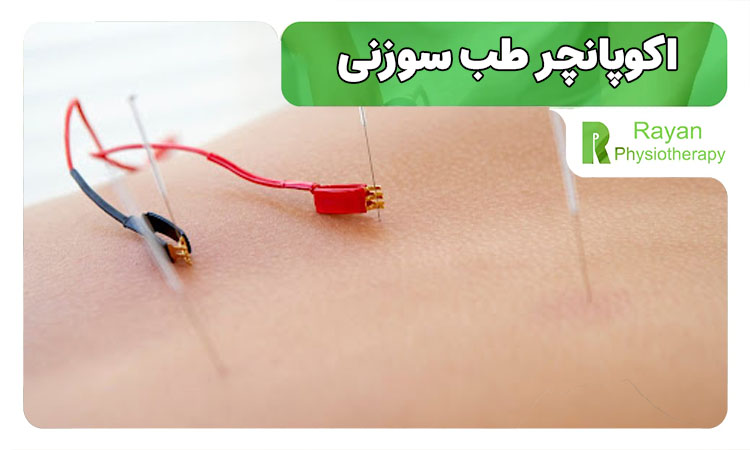 اکوپانچر 