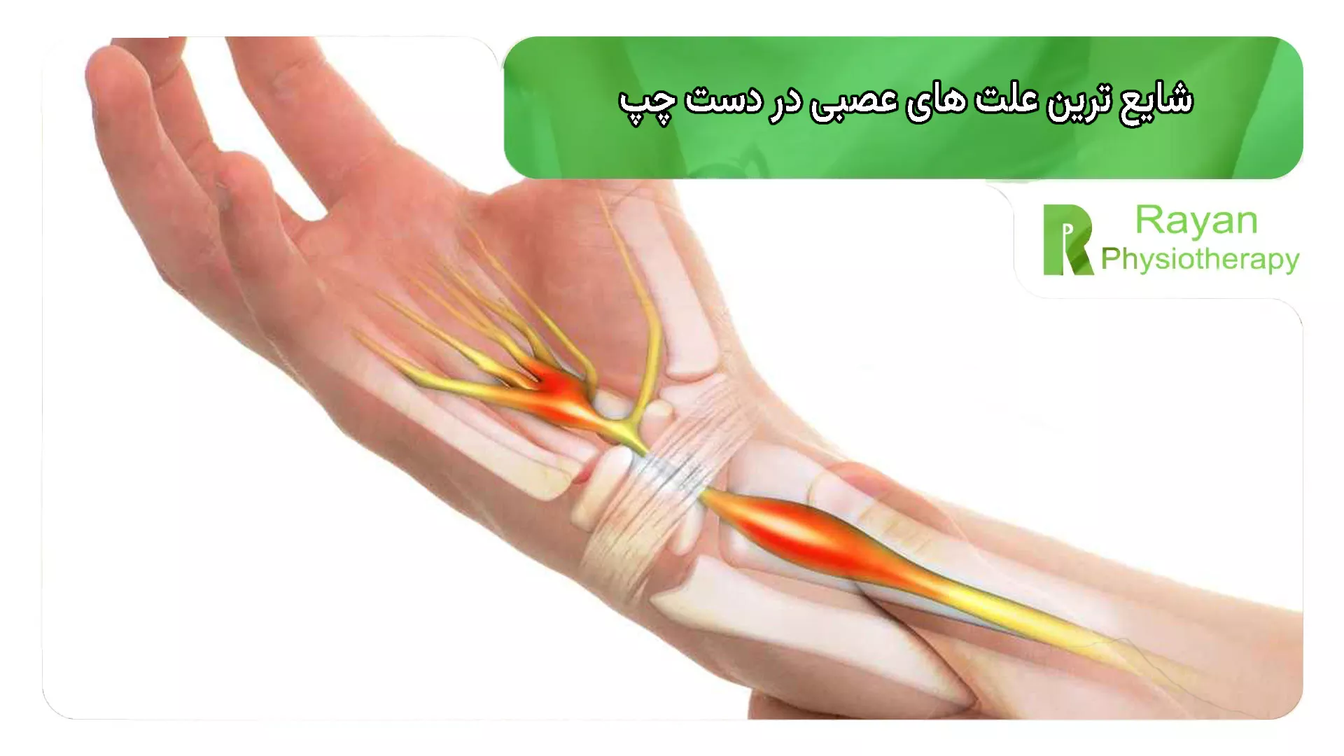 شایع ترین علت های عصبی در دست چپ