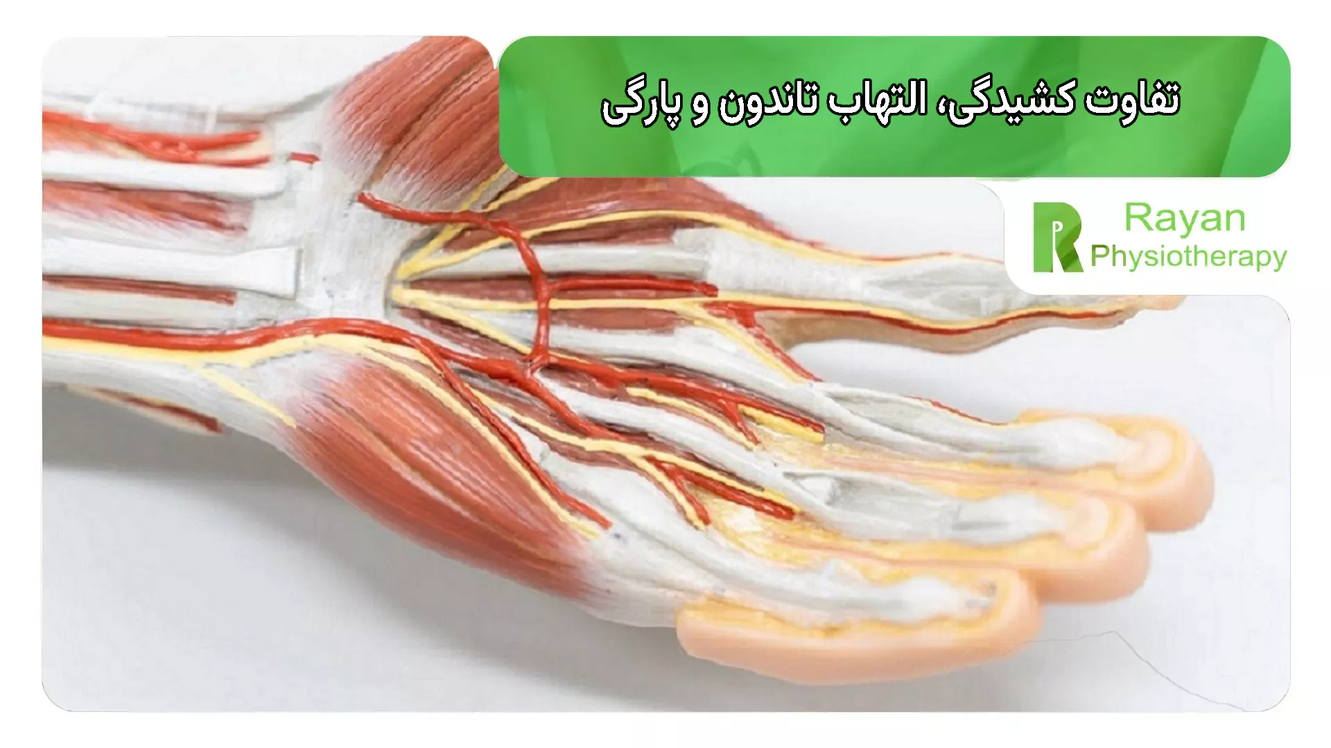 تفاوت کشیدگی، التهاب تاندون و پارگی