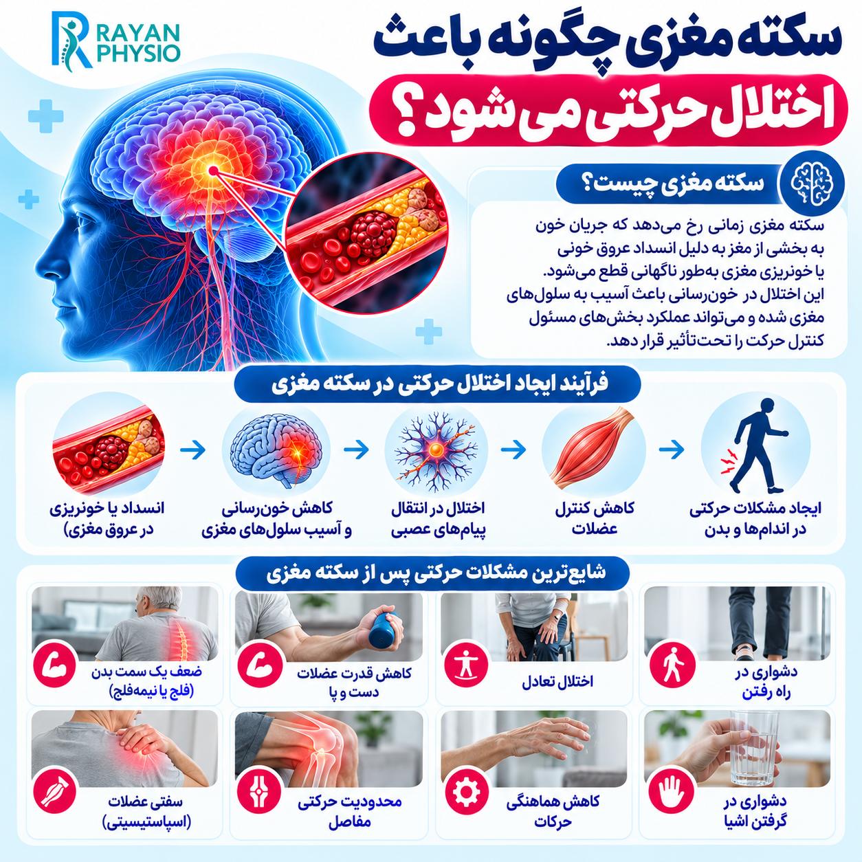 فیزیوتراپی سکته مغزی؛ توانبخشی و بازگشت حرکت